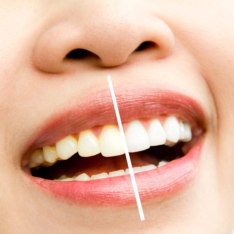 woman teeth before and after whitening. Over white background